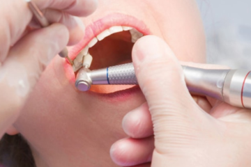 Có nên đánh bóng răng không? Những lưu ý khi thực hiện