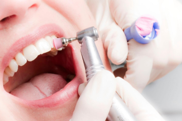 Có nên đánh bóng răng sứ không? Lưu ý khi thực hiện