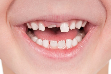  Có nên hàn răng sữa cho bé không? Nên lựa chọn vật liệu hàn nào?