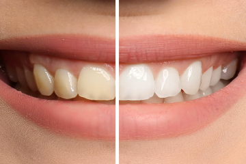 Có nên tẩy trắng răng? Tẩy trắng răng có hại men răng không? 