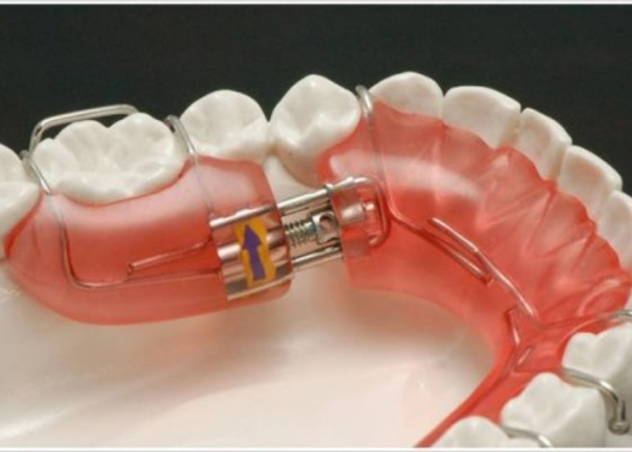 Có thể thực hiện vừa nong hàm vừa niềng răng được không?