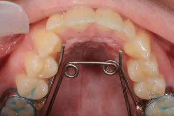 Đeo nong hàm bao lâu thì có thể đạt hiệu quả