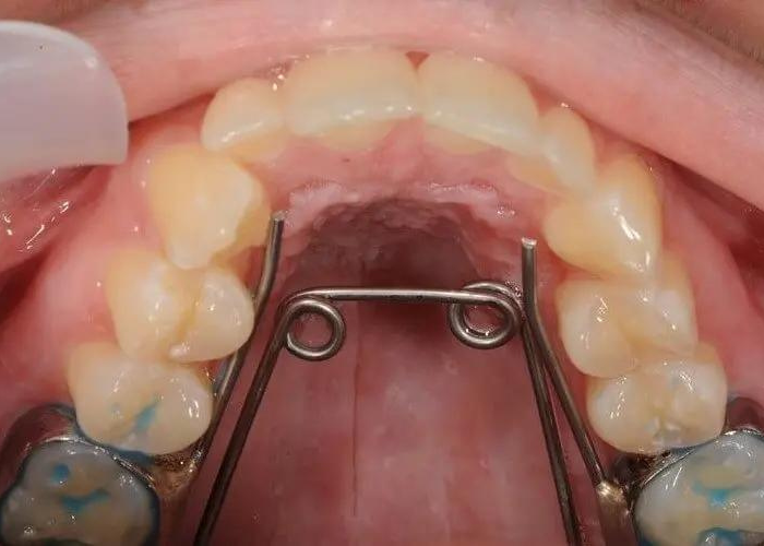 Đeo nong hàm bao lâu thì có thể đạt hiệu quả