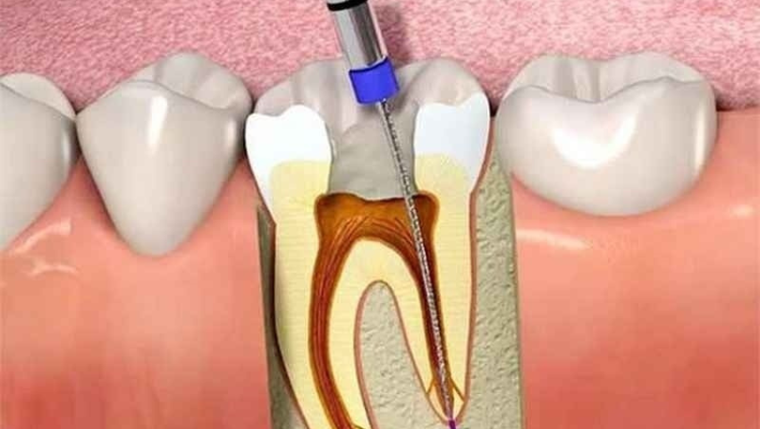 dieu-tri-tuy-rang-mat-bao-lau-cac-yeu-to-anh-huong-1