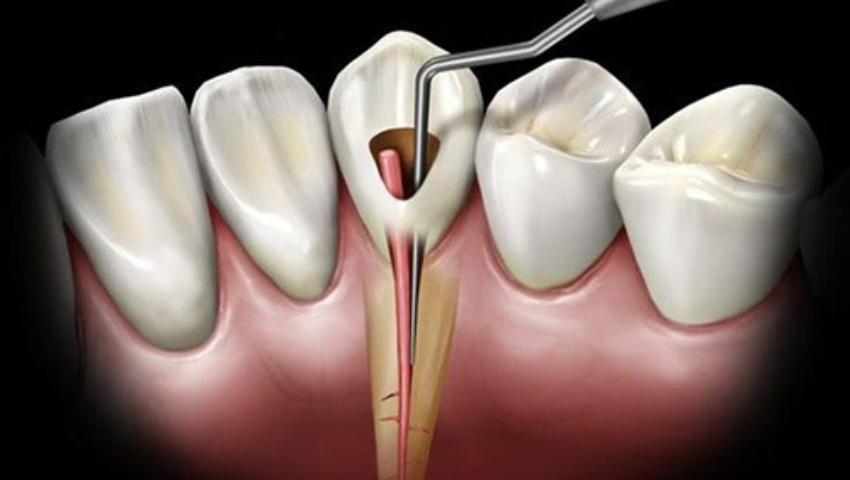 dieu-tri-tuy-rang-mat-bao-lau-cac-yeu-to-anh-huong-3