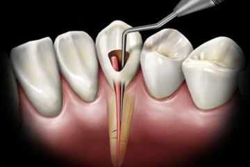 Điều trị tủy răng mất bao lâu? Các yếu tố ảnh hưởng