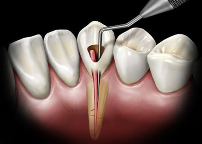 Điều trị tủy răng mất bao lâu? Các yếu tố ảnh hưởng
