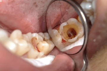 Điều trị tủy răng số 7: Nguyên nhân và quy trình điều trị