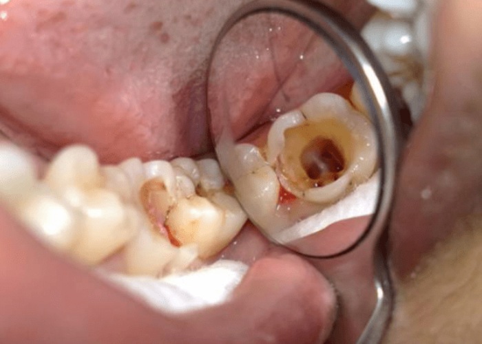 Điều trị tủy răng số 7: Nguyên nhân và quy trình điều trị