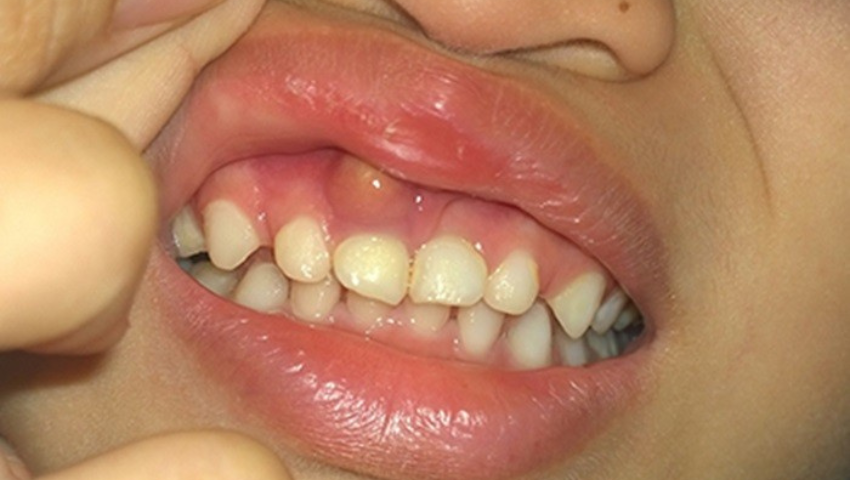 dieu-tri-viem-loi-o-tre-em-cha-me-can-luu-y-nhung-gi-1