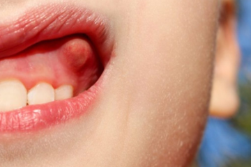 Điều trị viêm lợi ở trẻ em: Cha mẹ cần lưu ý những gì?