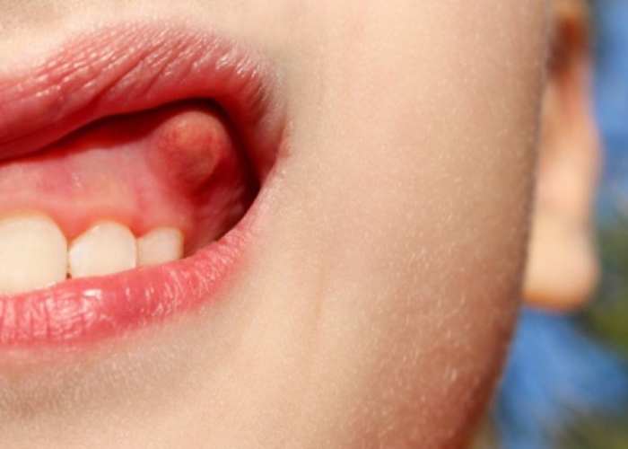 Điều trị viêm lợi ở trẻ em: Cha mẹ cần lưu ý những gì?