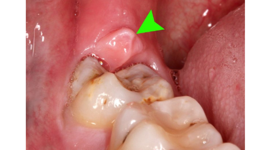 dieu-tri-viem-loi-trum-rang-khon-nhu-the-nao-1