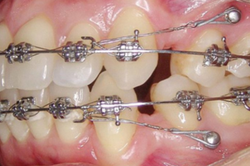 Gắn vít chỉnh nha để làm gì? Trường hợp nào cần gắn vít chỉnh nha?