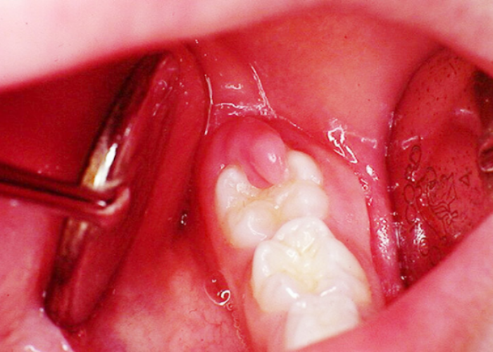 Giải đáp chi phí cắt lợi trùm răng khôn giá bao nhiêu?