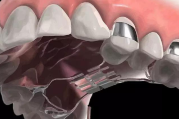 Giải đáp: Nong hàm có thay đổi khuôn mặt không?