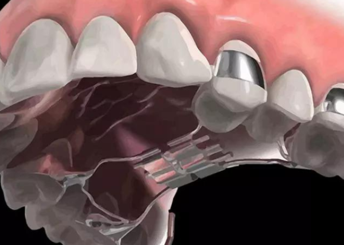 Giải đáp: Nong hàm có thay đổi khuôn mặt không?