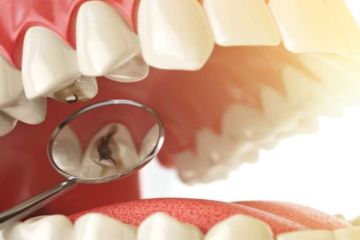 Hàn răng thẩm mỹ là gì? Các lưu ý cần biết