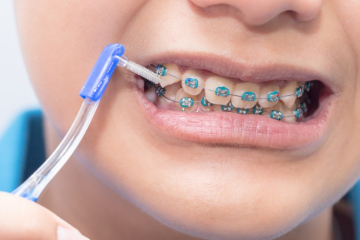 Minivis chỉnh nha là gì? Những trường hợp cần sử dụng?