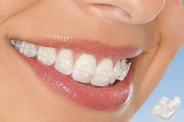 Những loại chỉnh nha mắc cài phổ biến hiện nay