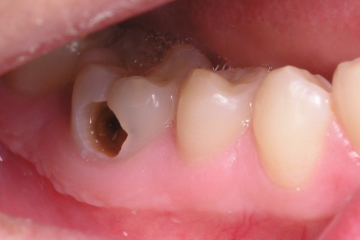 Những phương pháp điều trị răng chết tủy