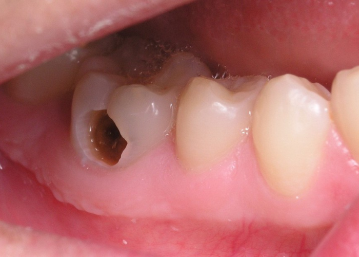Những phương pháp điều trị răng chết tủy