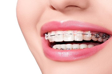 Niềng răng có tác dụng gì? Các loại khí cụ niềng răng chỉnh nha hiện nay
