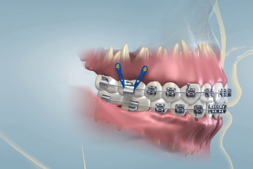 Niềng răng có thể cải thiện những tình trạng răng nào? Niềng răng có đau không?