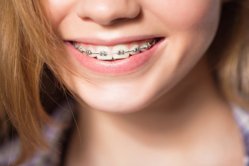 Niềng răng hô là gì? Các phương pháp niềng răng hô hiện nay