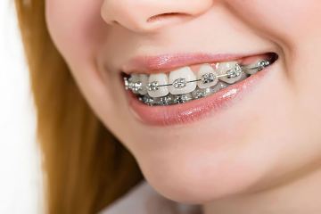 Niềng răng hô nhẹ giá bao nhiêu?