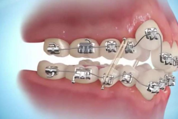 Niềng răng khểnh là gì? Các phương pháp niềng răng khểnh hiện nay 