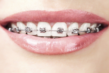 Niềng răng mắc cài là gì? Quy trình niềng răng mắc cài như thế nào?