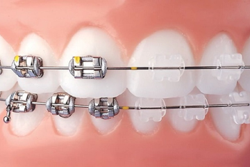 Niềng răng mắc cài trong suốt khác gì mắc cài thông thường