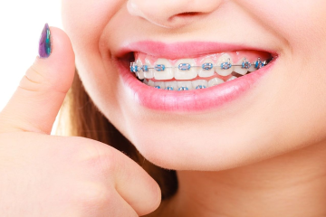 Niềng răng mất bao lâu? Quá trình niềng răng có mấy giai đoạn