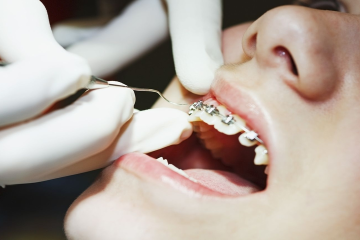 Niềng răng móm bao nhiêu tiền? Các phương pháp hiệu quả hiện nay