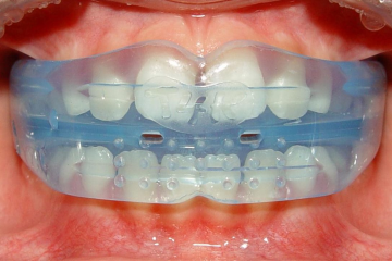 Niềng răng trainer có hiệu quả không? Ưu và nhược điểm là gì? 