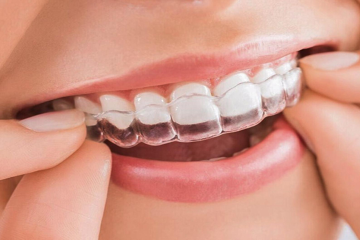 Niềng răng trong suốt Invisalign và những điều bạn cần biết