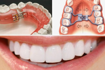 Nong hàm để làm gì? Những lưu ý sau khi nong hàm