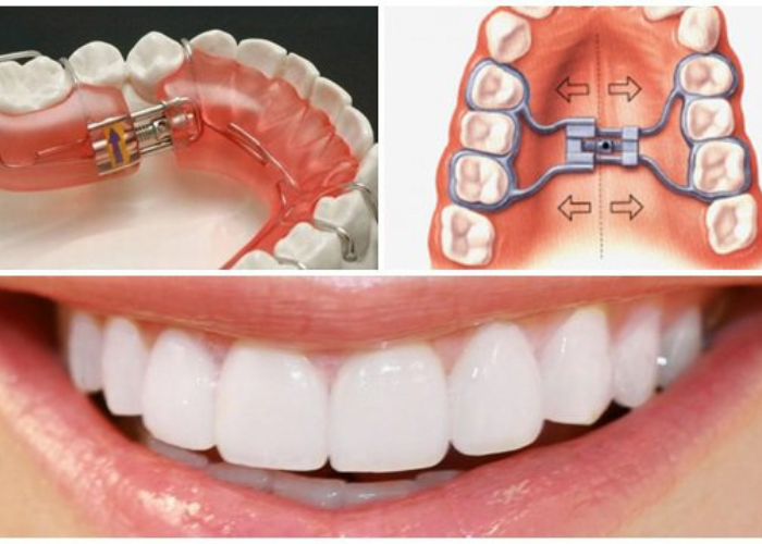 Nong hàm để làm gì? Những lưu ý sau khi nong hàm