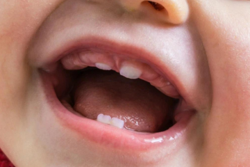 Phanh môi bám thấp là gì? Khi nào cần cắt phanh môi bám thấp?