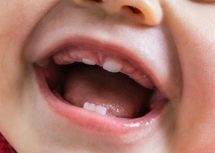 Phanh môi bám thấp là gì? Khi nào cần cắt phanh môi bám thấp?