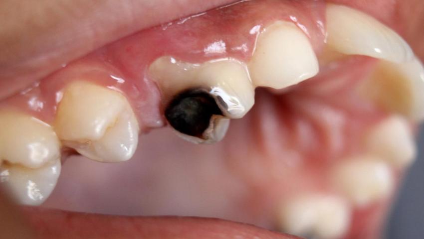 phuong-phap-dieu-tri-tuy-rang-sua-cho-tre-em-2