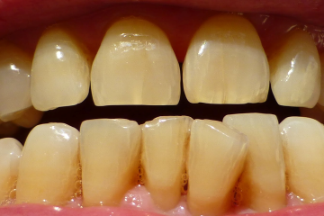 Răng bị ố vàng có tẩy trắng được không?