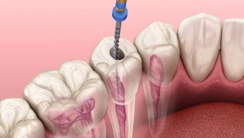 rang-sau-khi-dieu-tri-tuy-can-duoc-cham-soc-va-bao-ve-the-nao-1