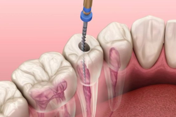 Răng sau khi điều trị tủy cần được chăm sóc và bảo vệ thế nào?