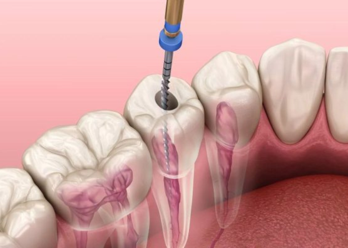 Răng sau khi điều trị tủy cần được chăm sóc và bảo vệ thế nào?