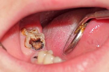 Răng số 8 bị sâu có hàn được không? Quy trình hàn răng số 8