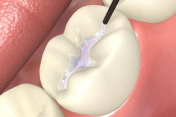 Răng sứ bị vỡ có hàn được không? Cách phòng tránh răng sứ bị mẻ