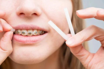 Sáp chỉnh nha là gì? Cách sử dụng sáp chỉnh nha