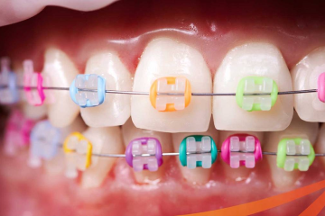 Sử dụng dụng cụ niềng răng tại nhà có hiệu quả không? 